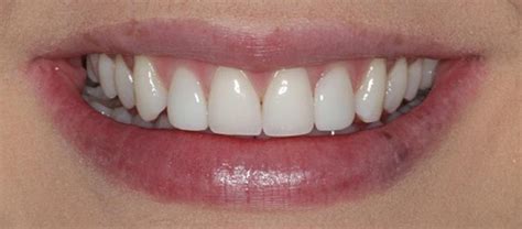 Composite Veneers and Teeth Whitening | Before & After Photos