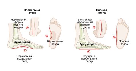 Плоскостопие - KinesioPro