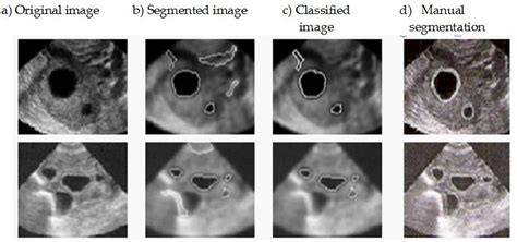 Follicle Detection and Ovarian Classification in Digital Ultrasound ...