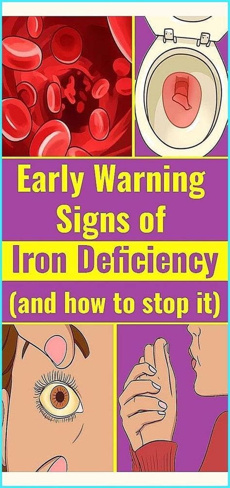 Iron Deficiency Symptoms Iron Deficiency Symptoms Signs Of Iron Deficiency Iron Deficiency