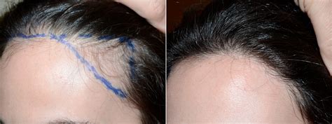 Hair Transplants For Women Photos Miami Fl Patient71499