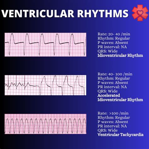 ecg ekg ventricular rhythms med tac international corp
