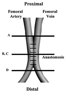 Diagram Of An Arteriovenous Fistula Between The Right Femoral Artery