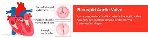 Bicuspid Aortic Valve - Causes, Symptoms, Complications, Diagnosis ...