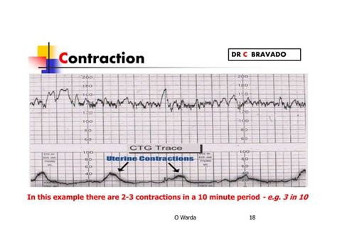 Cardiotocography Ctg Warda Ppt