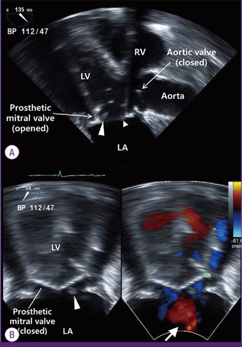 Transesophageal Echocardiography Performed The Day After Admission A