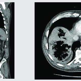 PDF Fulminant Emphysematous Hepatitis A Rare Cause Of Septic Shock