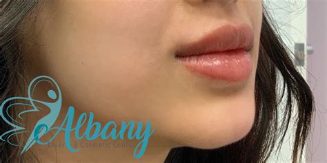 Lip Fillers Case 1357 Albany Cosmetic And Laser Centre