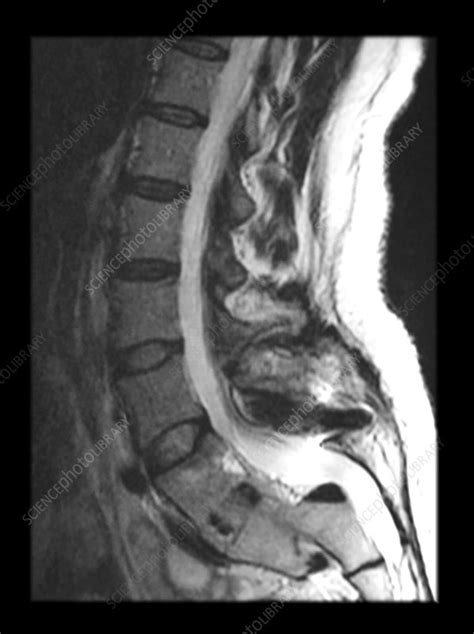 MRI of Lumbar Spondylolisthesis and Post Surgical Changes - Stock Image ...