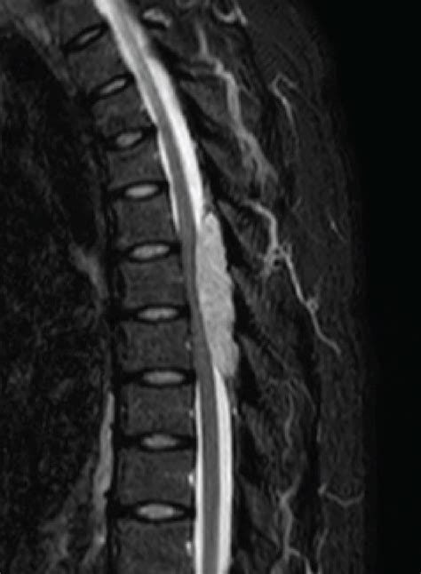 Preoperative Thoracic Mri A Heterogeneous Epidural Posterior Mass