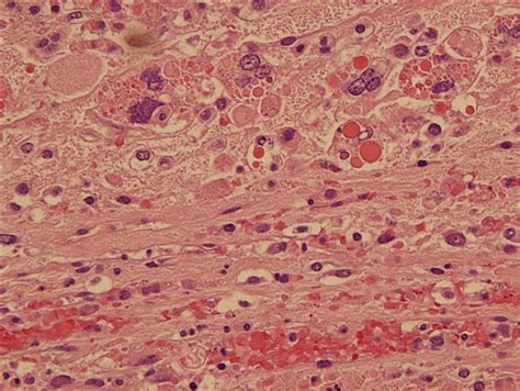 Pathology Outlines Undifferentiated Embryonal Sarcoma