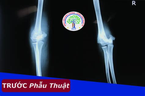 Chấn thương nhi Gãy trên hai lồi cầu xương cánh tay