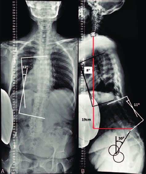 A And B Anteroposterior And Lateral Radiograph Of A 63 Yearold Female