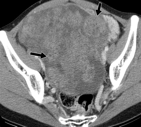 Imaging Findings of Complications and Unusual Manifestations of Ovarian