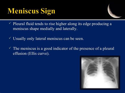 Pleural Fluid Tends To Rise Higher Along Its Edge Producing A Meniscus