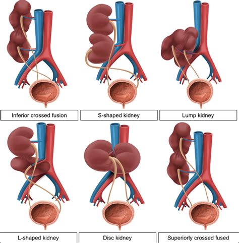 Unilateral Renal Agenesis Ultrasound Vs Pelvic Kidney