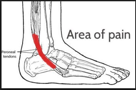 Podiatrists For Peroneal Tendon Surgery In High River