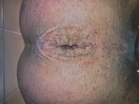 My Ass Opened Pics Xhamster