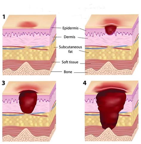 Understanding And Combating Pressure Ulcers The Sleep Judge