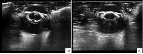 Preoperative ultrasound examination findings of right eye (a) and left ...