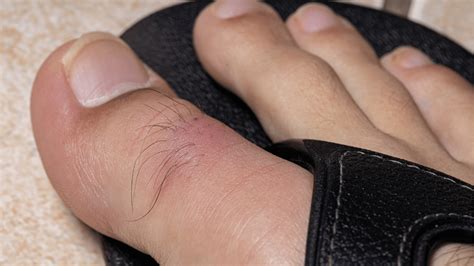 Treatment Options For Ingrown Hair And Herpes Clinikally