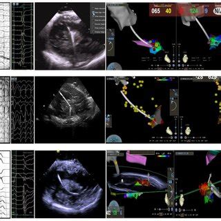 (A) Representative PVC body ECG of APM; (B) ECG of sinus rhythm and... | Download Scientific Diagram