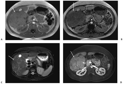 3 Liver Adenoma Radiology Key