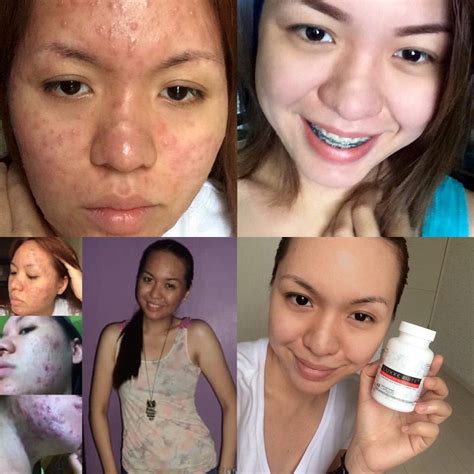 Luxxe White #1 Best Glutathione Brand for Skin Whitening – Frontrow
