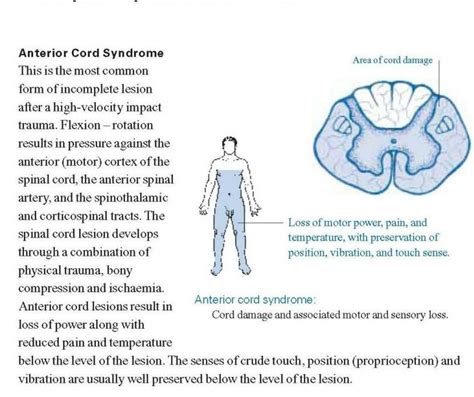 Anterior Cord Syndrome Spinal Cord Spinal Cord Injury Spinal