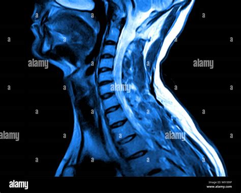 Resonancia Magn Tica De La Columna Cervical Fotograf As E Im Genes De