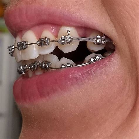 Braces Girlswithbraces Metalbraces Powerchain Braces Colors