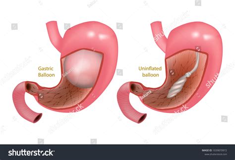 9 Intra Gastric Balloon Images Stock Photos Vectors Shutterstock