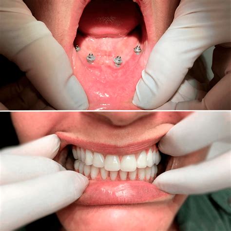 Implante Dentário Só Sorriso Odontologia Recreio Do Bandeirantes