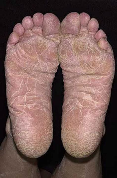 Imagetinea Pedis Moccasin Distribution Msd Manual Professional Edition