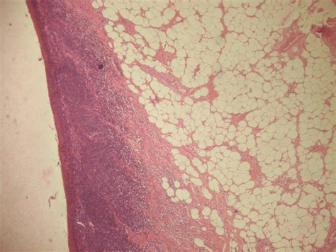 Proliferation Of Mature Adipocytes Covered By A Nonkeratinizing