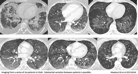 E Cigarette Or Vaping Associated Lung Injury Evali Emcrit Project