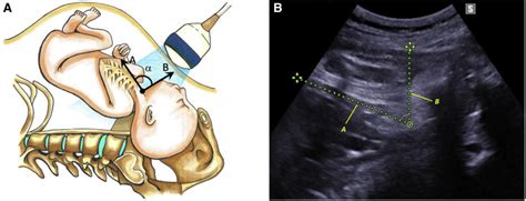 Intrapartum Sonographic Assessment Of The Fetal Head Flexion In Protracted Active Phase Of Labor