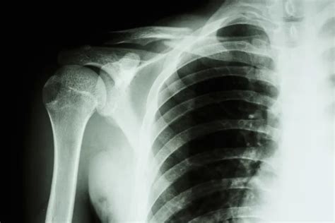 Fracture right clavicle Stock Photo by ©stockdevil_666 61372315