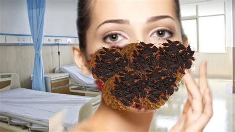 Asmr Removal Black Trypophobia Treatment Asmr 2d Animation Treatment