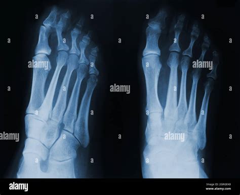 Foot Xray Hi Res Stock Photography And Images Alamy