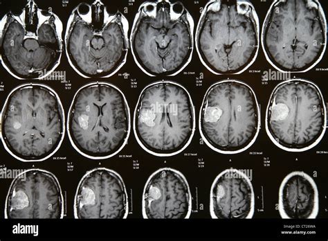 Mri Meningioma Hi Res Stock Photography And Images Alamy