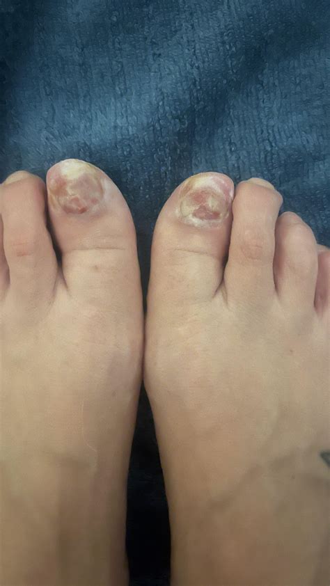 Post permanent toenail removal : r/Ingrown_Toenails