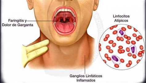 11 Remedios Caseros Para Ganglios Linfáticos Inflamados