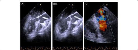 Intraoperative transesophageal echocardiography(TEE). A, B TEE images... | Download Scientific ...