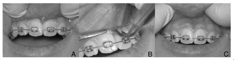 Management Of The Maxillary Midline Diastema Caused By An Abnormal