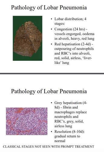 Infections Of The Lung Flashcards Quizlet