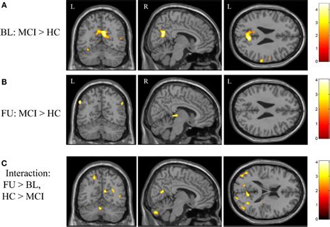 Frontiers Cholinergic Enhancement Of Brain Activation In Mild