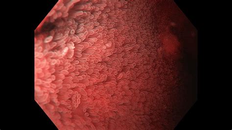 normal duodenal mucosa  water egd nbi zoom youtube