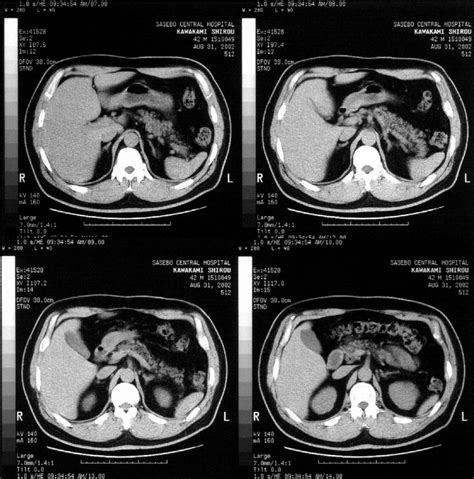 Abdominal Ct Scan Showed Almost Normal Adrenal Glands With Slight