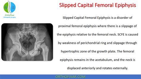 Slipped Capital Femoral Epiphysis | OrthoFixar 2025